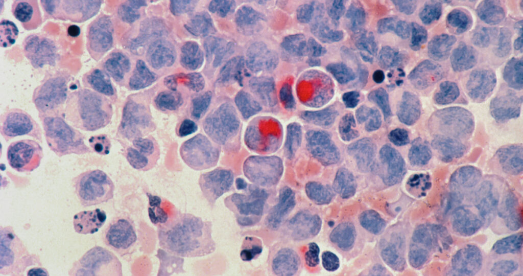 leucemia