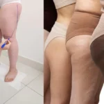 que es lipedema