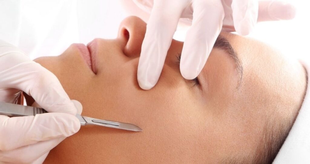 dermaplaning