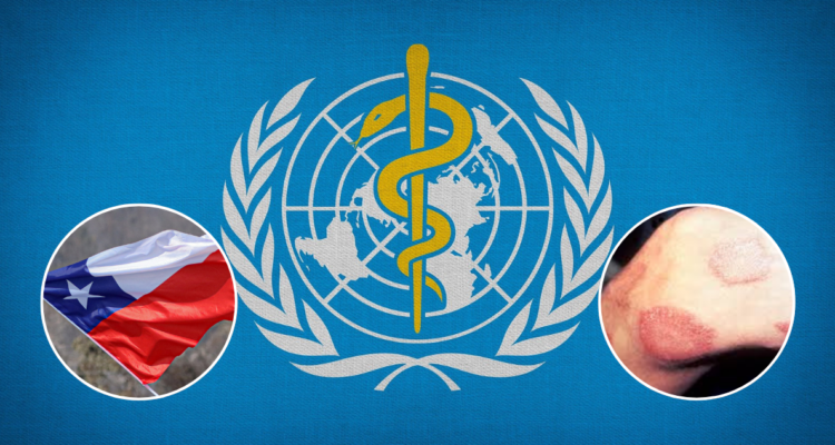 oms reconoce a chile como segundo pais en erradicar la lepra no han existido casos en mas de 30 anos 750x400 1