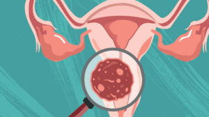 cervicouterino