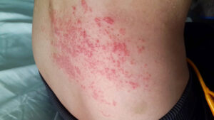 herpes zoster